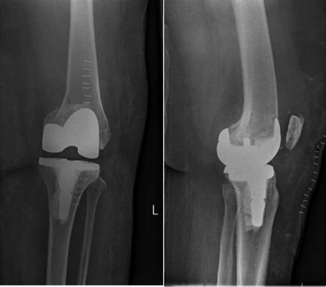 Radiographs Of Case 1 Showing An Insufficiency Fracture Of The Medial