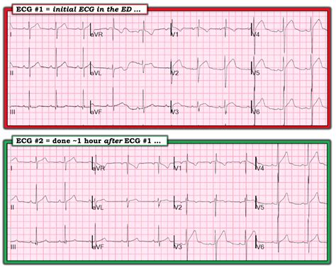 Dr Smiths Ecg Blog Chest Pain And Convex St Elevation In Precordial