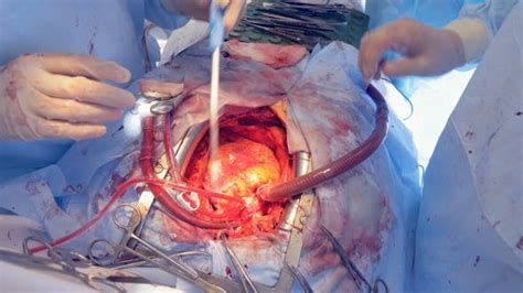 Heart Beating During Real Surgery Open Cardiac Surgery By