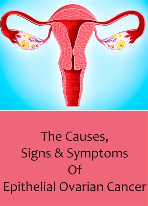 The Causes Signs And Symptoms Of Epithelial Ovarian Cancer Lady Care