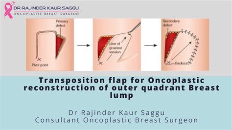 Transposition Flap For Breast Reconstruction Best Breast Oncoplastic
