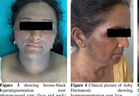 Clinical And Histopathological Features Of Lichen Planus Hot Sex Picture