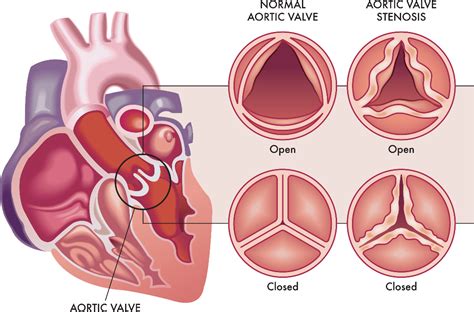 What Are Aortic Stenosis Symptoms And Causes Dr C Raghu