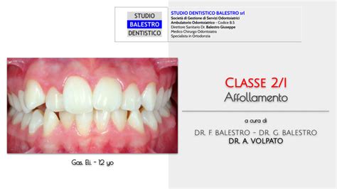 Studio Dentistico Balestro Malocclusione Di Classe I