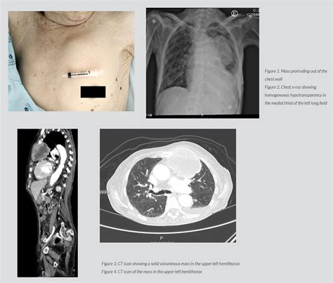 Figure 4 From Hypercalcemia And Extensive Chest Metastasis Of Vulvar