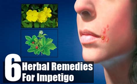 Top 6 Herbal Remedies For Impetigo Natural Home Remedies And Supplements