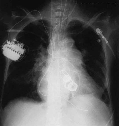 Pacemaker And Artificial Heart Valves Buyxraysonline