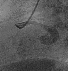 Category X Rays Of Coronary Arterial Fistulas Wikimedia Commons