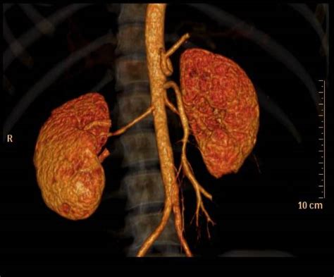 Fibromuscular Dysplasia Definition Diagnosis And Treatment