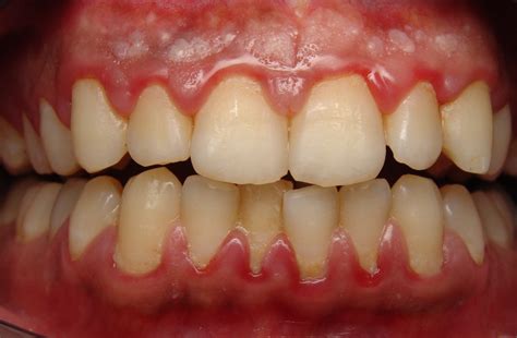 Gum Disease How Can I Tell Cranbourne North Dental