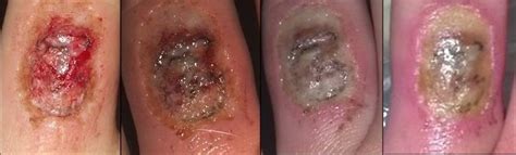 Newer tattoo removal techniques can eliminate tattoos with minimal side effects. Risks of Non-Laser Tattoo Removal Methods
