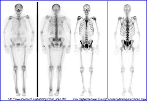 42 Nm Whole Body Bone Scan Png