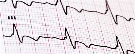 Eine herzmuskelentzündung beginnt oft schleichend und unauffällig: Praxis für Kardiologie Aachen - Leistungsspektrum