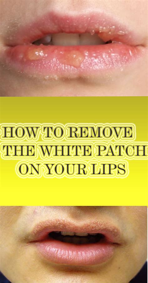 How To Get Rid Of Fordyce Spots On Lips At Home Ideas Do Yourself Ideas
