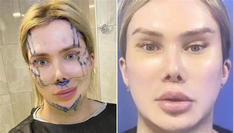 Uk Born Influencer Oli London Spends Thousands On Plastic Surgery To