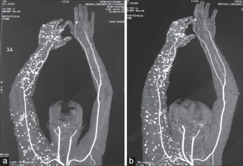 Occlusion of the arteria radialis dextra. Klippel-Trenaunay syndrome with review of literature Reddy ...