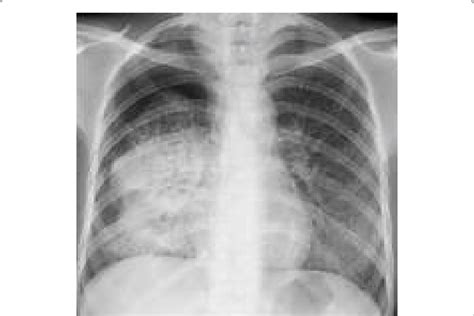 Chest X Ray Showing Dense Homogenous Opacity In Right Middle And Lower