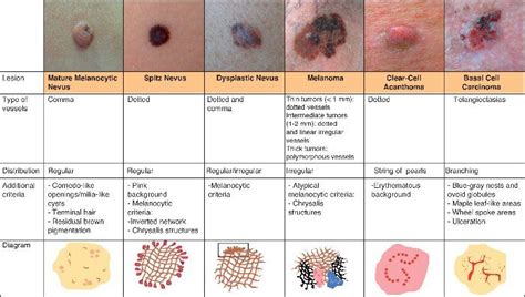 Squamous Cell Basal Cell Squamous Cell Carcinoma