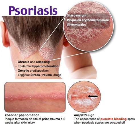 Rosh Review Dermatology Nurse Psoriasis Dermatology