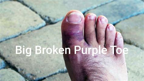 Big Broken Purple Toe Youtube