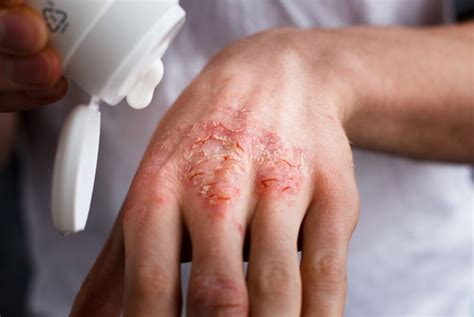 Frequently Asked Questions About Contact Dermatitis Facty Health