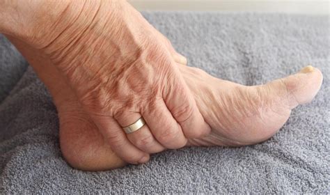 What Is Idiopathic Peripheral Neuropathy With Pictures