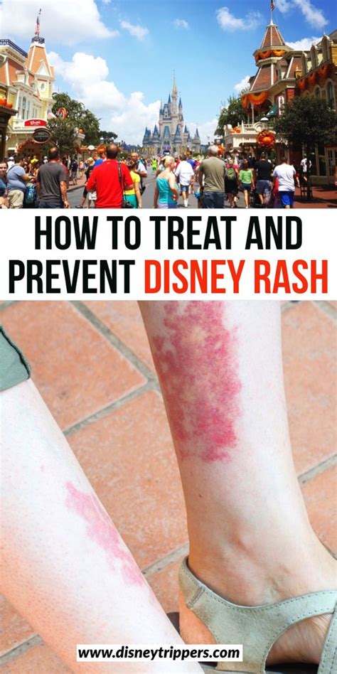 How To Treat And Prevent Disney Rash Pictures Tips And More Artofit