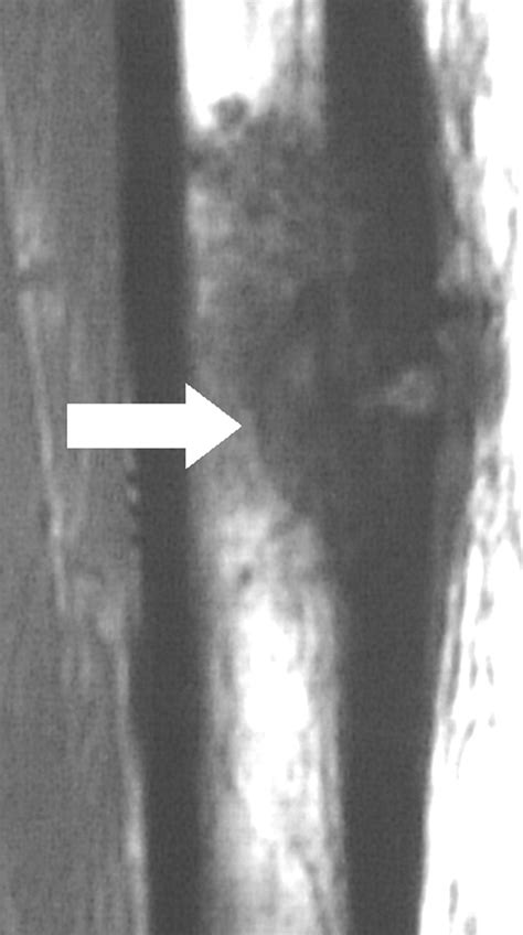 Mri Features After Radiofrequency Ablation Of Osteoid Osteoma With