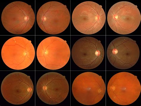 Pdf Improved Automated Detection Of Diabetic Retinopathy On A