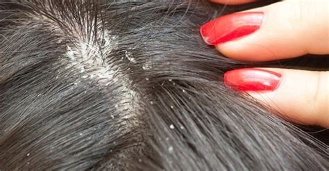 What Do Lice And Nits Look Like In The Hair Quora