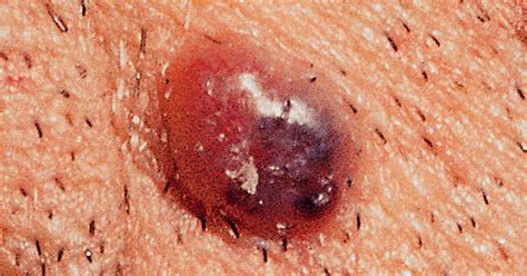 Is It Skin Cancer 38 Photos That Could Save Your Life Pictures Cbs News