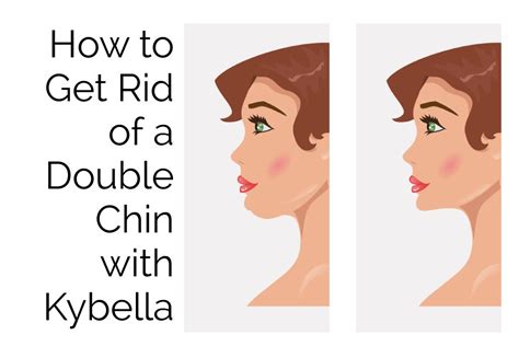How To Get Rid Of A Double Chin With Kybella