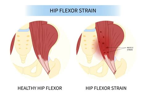 Strengthening Hip Flexor Exercises For Seniors