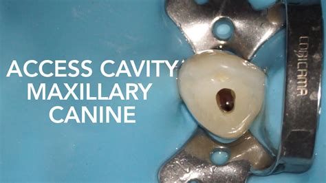 Pre Clinical Endodontic Access Cavity Of Maxillary Canine Youtube