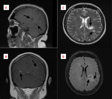 Cureus Tumefactive Multiple Sclerosis A Rare Variant Presenting As