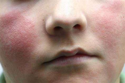 What Is Slapped Cheek Syndrome Lowton And Golborne News