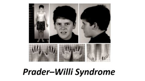 Praderwilli Syndrome Definition Symptoms Causes And Treatment