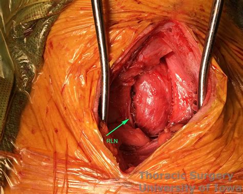 Minimally invasive esophagectomy (mie) is a complex and technically demanding procedure with a long learning curve, which is associated with increased morb. Esophagectomy: Cervical gastroesophageal anastomosis ...