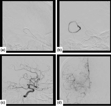 Embolization Angiogram A Balloon Occlusion Test B Proximal
