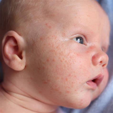 Baby Skin Issues And Conditions What To Expect
