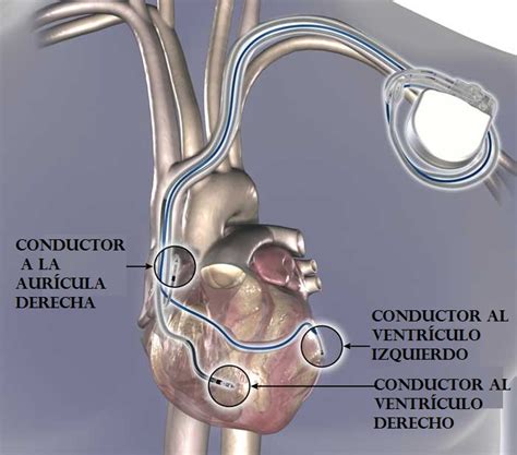 Excelentes artículos de desfibrilador cardíaco. CubaesDiversa: Retorno con Actualización (Comeback with ...