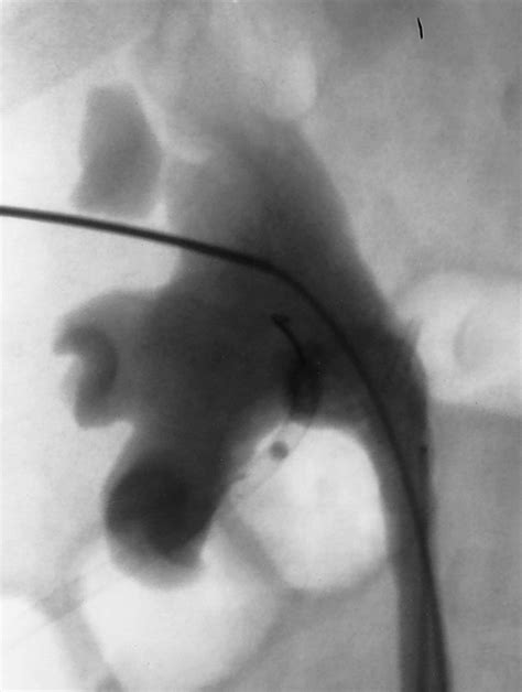 Percutaneous Nephrostomy With Extensions Of The Technique Step By Step
