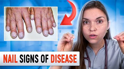 Doctor Explains What Your Nails Say About Your Health Top 10 Nail