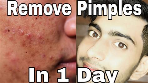 How To Remove Pimples Overnight Remove Pimples In 1 Day My