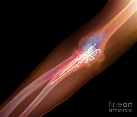 Pinned Elbow Fracture X Ray Photograph By Francoise Sauzescience Photo