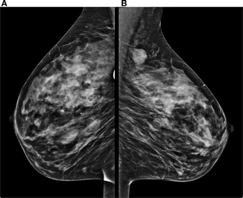 Mammogram Performed With Mediolateral Oblique Incidences Of Both