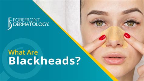 What Are Blackheads Forefront Dermatology