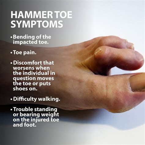 Hammer Toe And Toe Joints Florida Orthopaedic Institute