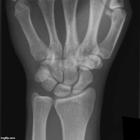 Emrad Radiologic Approach To The Traumatic Wrist Med Tac