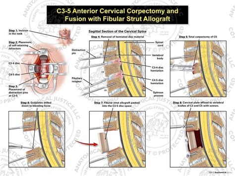 C3 5 Anterior Cervical Corpectomy And Fusion With Fibular Strut Graft